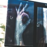 ossos, mão, radiografia,
