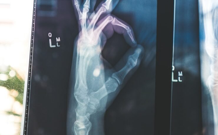 ossos, mão, radiografia,