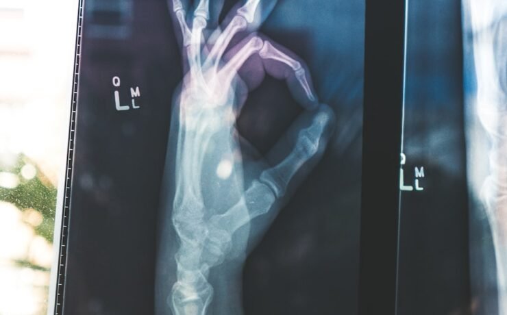 bones, hand, radiography,